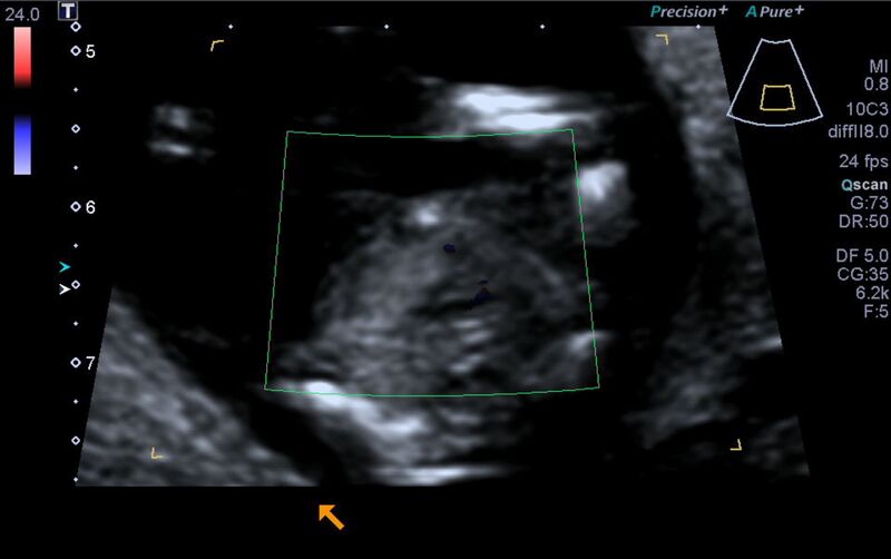 File:1st trimester nuchal-morphology ultrasound (Radiopaedia 44706-48477 Heart views cine with colour 145).jpg