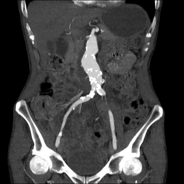 File:Abdominal aortic aneurysm (Radiopaedia 23703-23856 Coronal C+ arterial phase 10).jpg