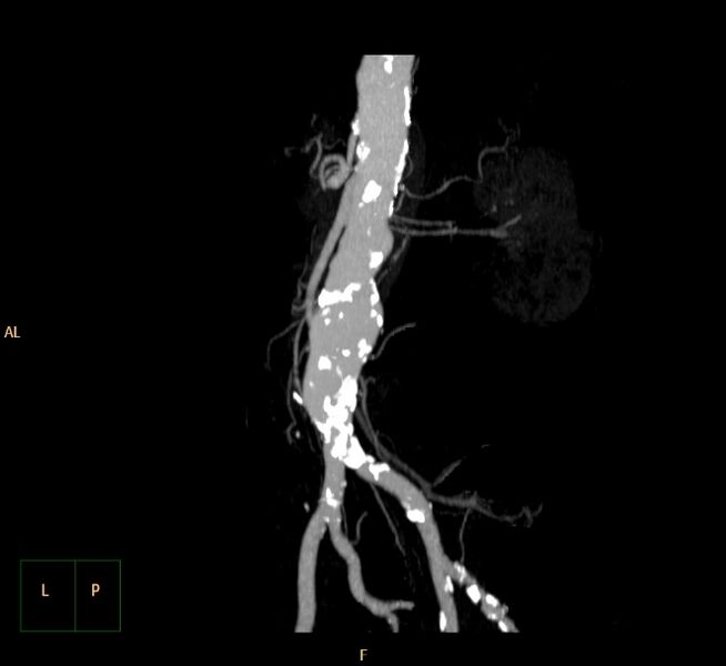 File:Abdominal aortic aneurysm (Radiopaedia 23703-23856 MIP 17).jpg