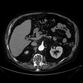 Abdominal aortic aneurysm (Radiopaedia 25855-26001 Axial C+ arterial phase 46).jpg