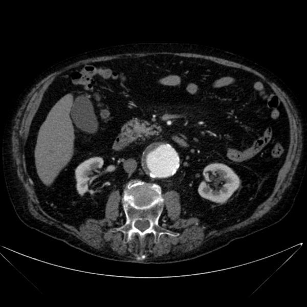 File:Abdominal aortic aneurysm (Radiopaedia 25855-26001 Axial C+ arterial phase 59).jpg