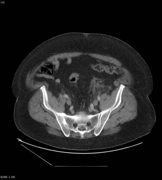 File:Abdominal aortic aneurysm with intramural hematoma then rupture (Radiopaedia 50278-55631 Axial C+ arterial phase 103).jpg