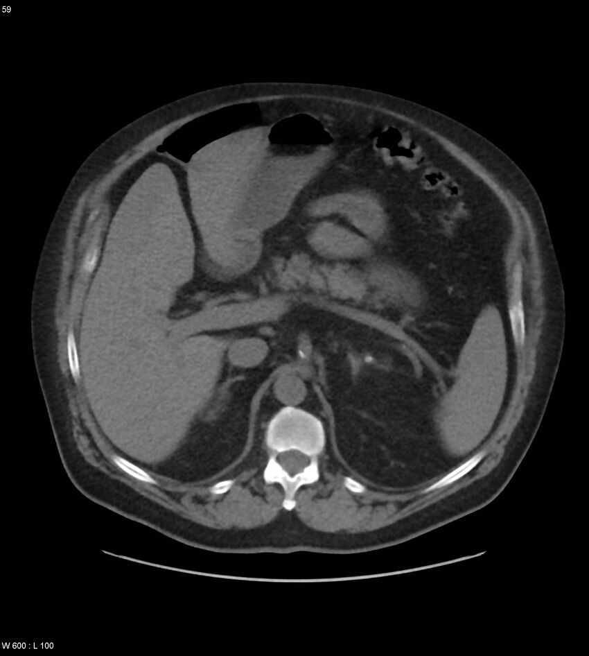 Abdominal aortic aneurysm with intramural hematoma then rupture (Radiopaedia 50278-55631 Axial non-contrast 55).jpg