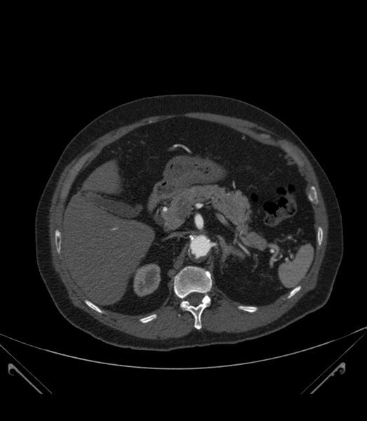 File:Abdominal aortic aneurysm with thrombus fissuration (Radiopaedia 46218-50618 Axial C+ arterial phase 11).jpg