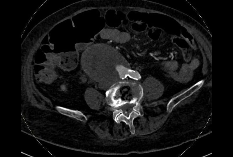 File:Abdominal aortic aneurysm with thrombus fissuration (Radiopaedia 73192-83919 Axial C+ arterial phase 135).jpg