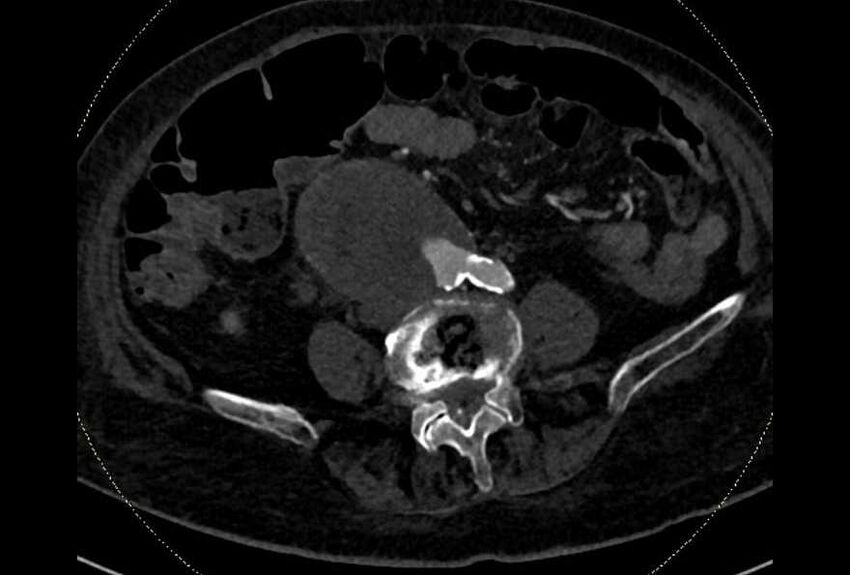 Abdominal aortic aneurysm with thrombus fissuration (Radiopaedia 73192-83919 Axial C+ arterial phase 135).jpg