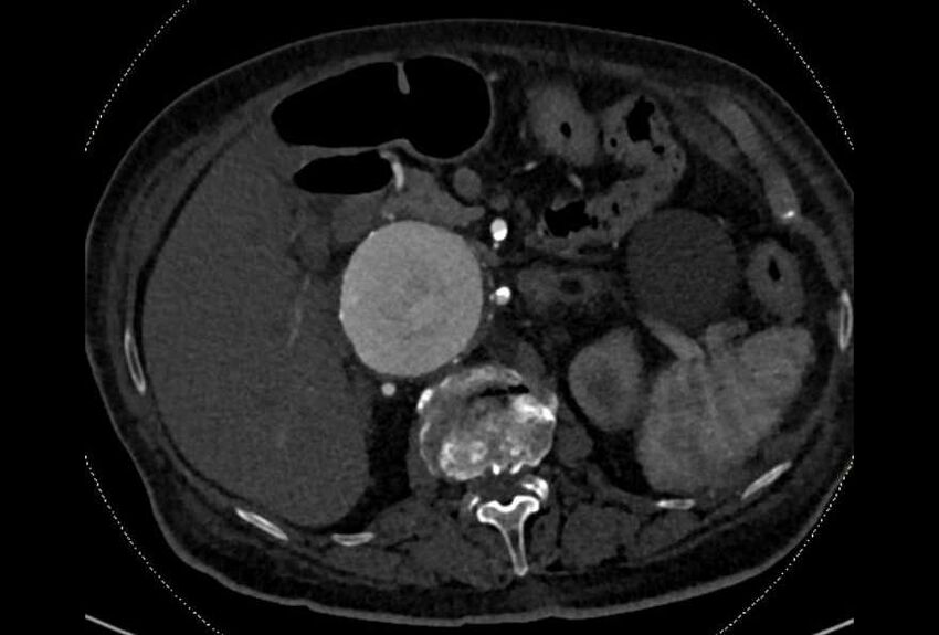 Abdominal aortic aneurysm with thrombus fissuration (Radiopaedia 73192-83919 Axial C+ arterial phase 47).jpg