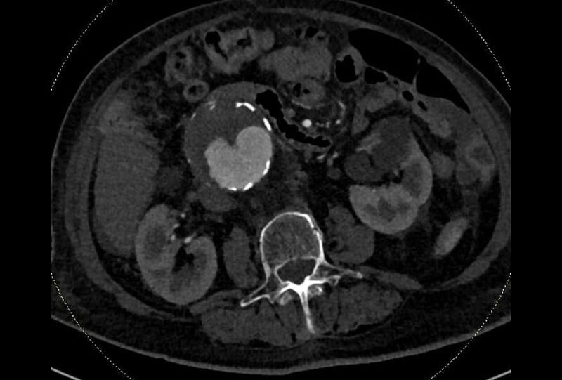 File:Abdominal aortic aneurysm with thrombus fissuration (Radiopaedia 73192-83919 Axial C+ arterial phase 83).jpg