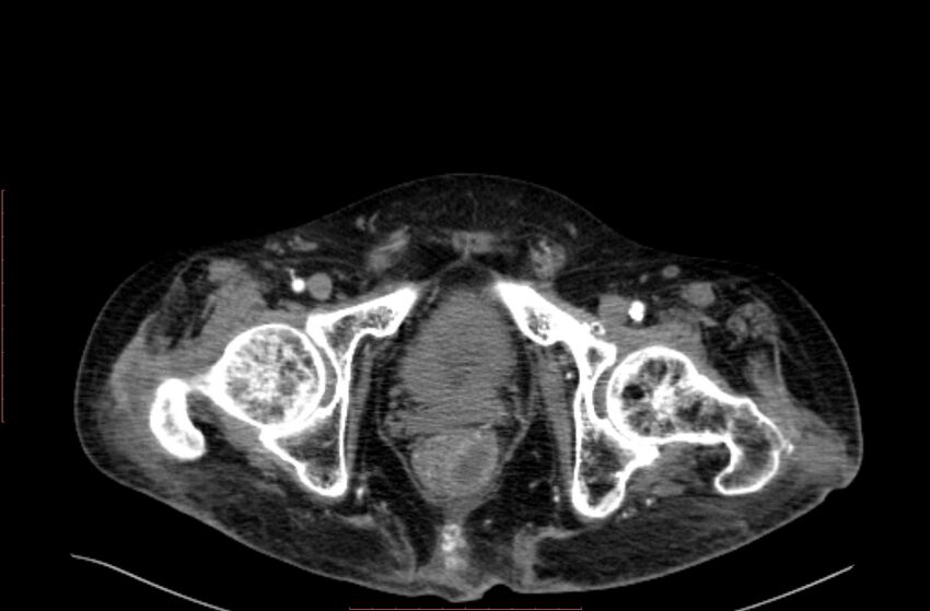 Abdominal aortic interposition tube graft and aneurysm thrombosis (Radiopaedia 71438-81857 Axial C+ arterial phase 239).jpg