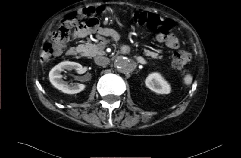File:Abdominal aortic interposition tube graft and aneurysm thrombosis (Radiopaedia 71438-81857 Axial C+ arterial phase 49).jpg