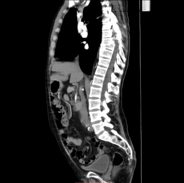 File:Abdominal aortic interposition tube graft and aneurysm thrombosis (Radiopaedia 71438-81857 Sagittal C+ arterial phase 18).jpg
