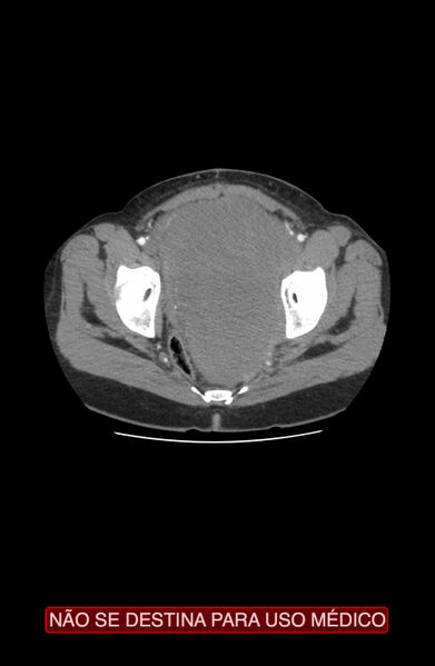 File:Abdominal desmoid tumor (Radiopaedia 44024-47540 Axial C+ arterial phase 47).jpg