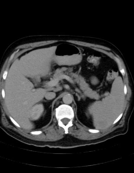 File:Abdominal lymphoma - with sandwich sign (Radiopaedia 53486-59492 Axial C+ portal venous phase 14).jpg