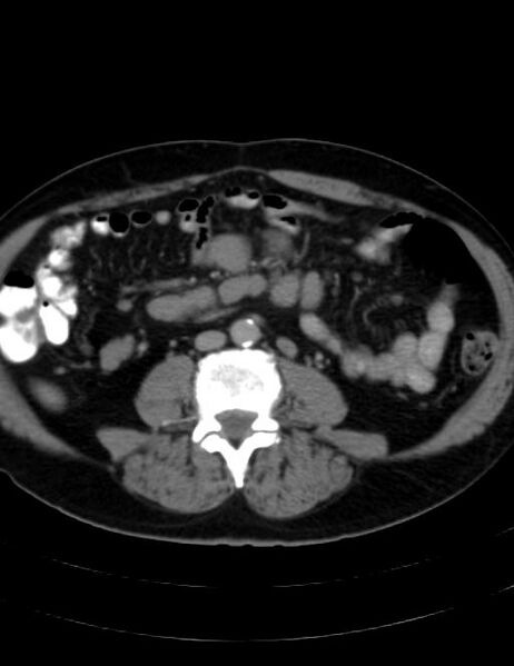 File:Abdominal lymphoma - with sandwich sign (Radiopaedia 53486-59492 Axial C+ portal venous phase 29).jpg
