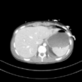 Abdominal multi-trauma - devascularised kidney and liver, spleen and pancreatic lacerations (Radiopaedia 34984-36486 Axial C+ portal venous phase 13).png