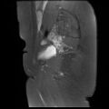 Abdominal wall endometriosis (Radiopaedia 83702-98847 Sagittal T1 C+ fat sat 4).jpg