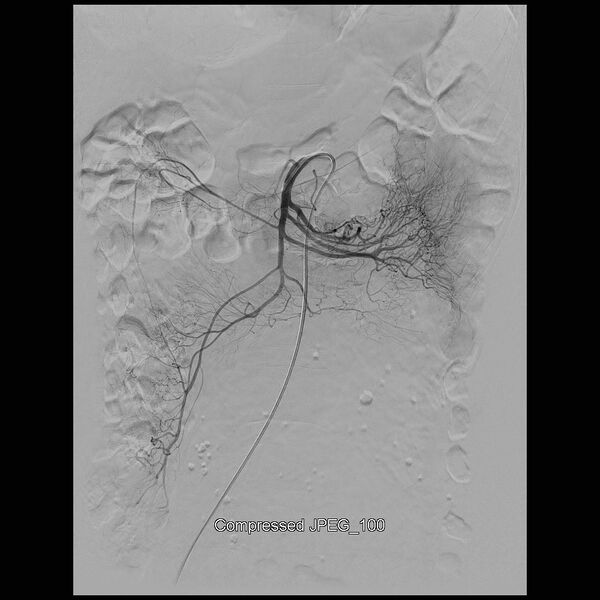 File:Abernethy malformation (Radiopaedia 42006-45462 Frontal Superior mesenteric artery 5).jpg