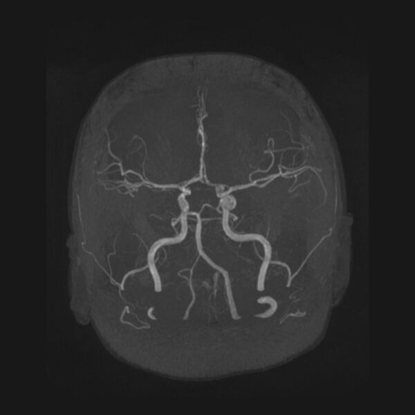 File:Accessory middle cerebral artery and ICA aneurysm (Radiopaedia 22656-22674 B 8).jpg