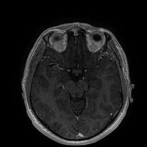 File:Acoustic schwannoma - intracanalicular (Radiopaedia 37247-39024 Axial T1 C+ 109).jpg