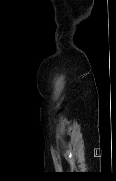 File:Active Crohn disease (Radiopaedia 59394-66750 Sagittal C+ portal venous phase 3).jpg