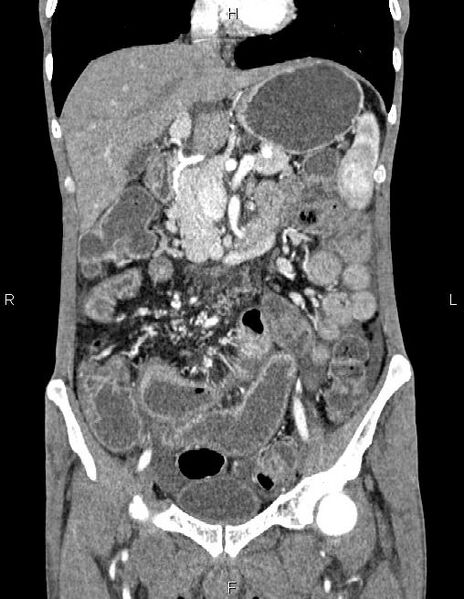 File:Active crohn disease (Radiopaedia 87133-103397 Coronal C+ arterial phase 26).jpg
