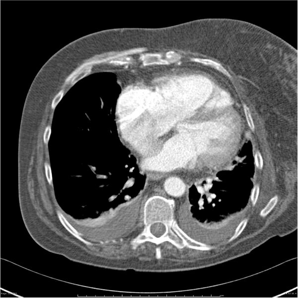 File:Acute-on-chronic pulmonary emboli (Radiopaedia 27925-28169 C+ CTPA 52).jpg