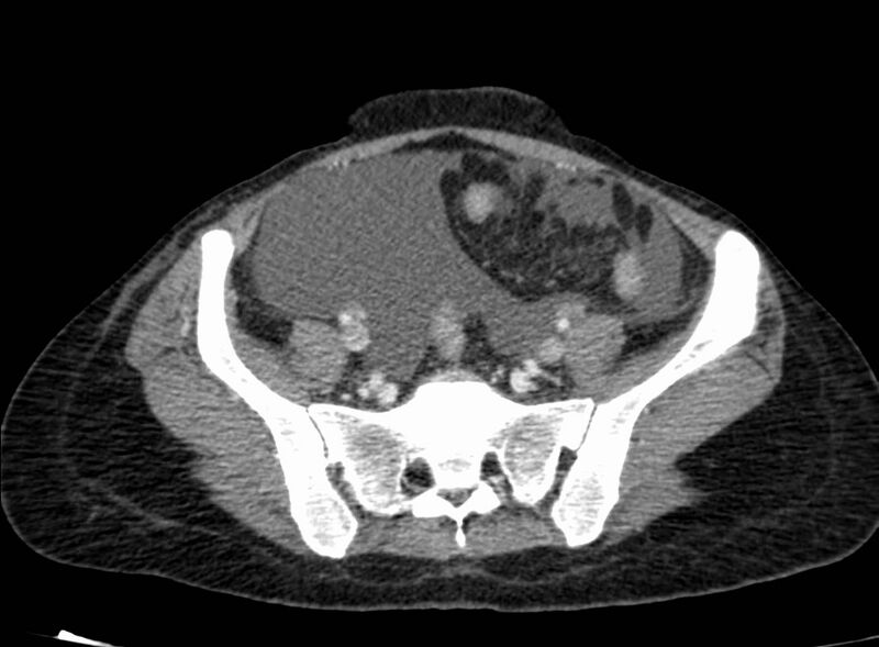 File:Acute Budd-Chiari syndrome (Radiopaedia 60858-68638 Axial C+ portal venous phase 229).jpg
