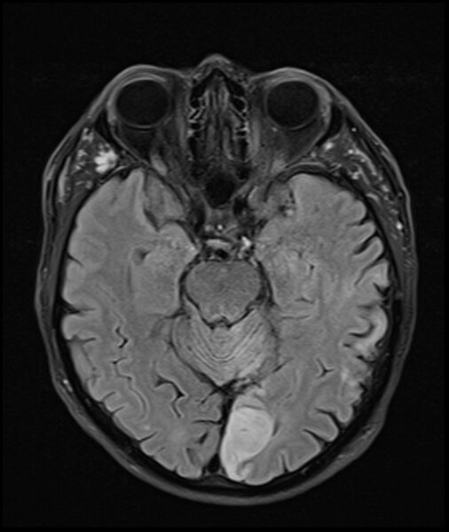 File:Acute P1 occlusion with PCA ischemia penumbra (CT perfusion) (Radiopaedia 72084-82590 Axial FLAIR 13).jpg