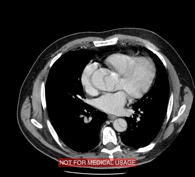 File:Acute aortic dissection - Stanford type A (Radiopaedia 40661-43285 Axial C+ portal venous phase 32).jpg