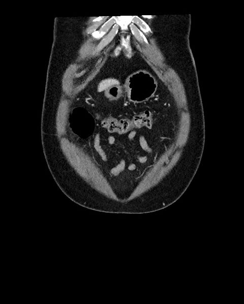 File:Acute appendicitis - large appendicoliths (Radiopaedia 61805-69820 Coronal C+ portal venous phase 21).jpg