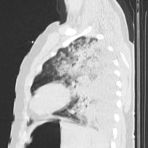 File:Acute aspiration pneumonitis (Radiopaedia 33605-34703 Sagittal lung window 64).jpg