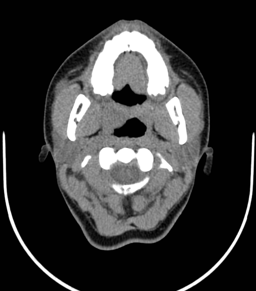 File:Acute bacterial tonsillitis (Radiopaedia 22882-22908 Axial non-contrast 13).png