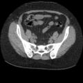 Acute cholecystitis and ureteric colic (Radiopaedia 42330-45444 Axial prone 82).jpg