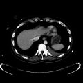 Acute myocardial infarction in CT (Radiopaedia 39947-42457 Axial C+ portal venous phase 17).jpg