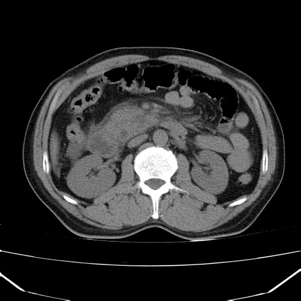 File:Acute pancreatitis (Radiopaedia 22572-22596 Axial non-contrast 27).jpg