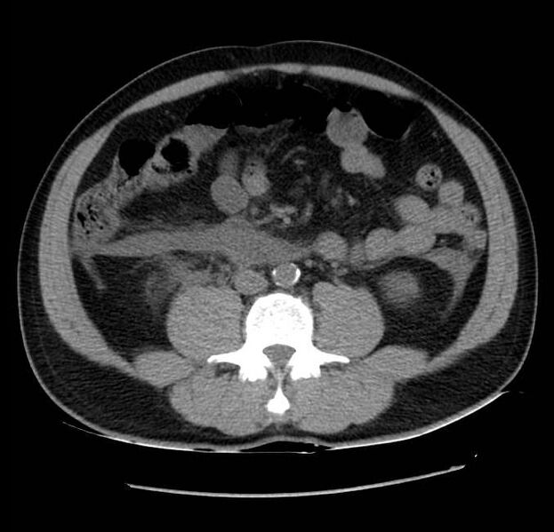 File:Acute pancreatitis - Balthazar E (Radiopaedia 23080-23110 Axial non-contrast 40).jpg