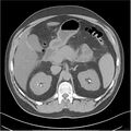 Acute pancreatitis - mild (Radiopaedia 27796-28033 Axial non-contrast 10).jpg