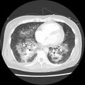 Acute pulmonary edema on CT (Radiopaedia 33582-34672 Axial lung window 34).jpg