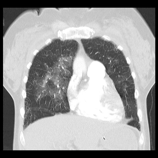 File:Acute pulmonary edema on CT (Radiopaedia 33582-34672 Coronal lung window 9).jpg