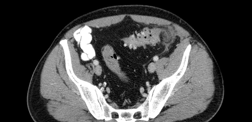 Acute sigmoid colon diverticulitis (Radiopaedia 55507-61976 Axial C+ portal venous phase 86).jpg