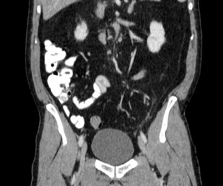 File:Acute sigmoid colon diverticulitis (Radiopaedia 55507-61976 Coronal C+ portal venous phase 76).jpg