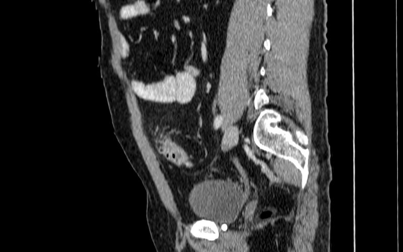 File:Acute sigmoid colon diverticulitis (Radiopaedia 55507-61976 Sagittal C+ portal venous phase 39).jpg