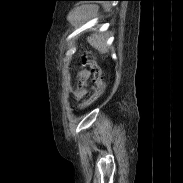 File:Acute tubular necrosis (Radiopaedia 28077-28334 H 76).jpg