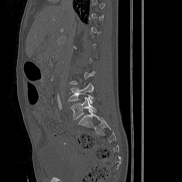 File:Acute vertebral body compression fractures (Radiopaedia 31757-32693 Sagittal bone window 36).jpg