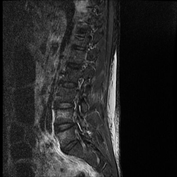 File:Acute vertebral body compression fractures (Radiopaedia 31757-32694 Sagittal STIR 12).jpg