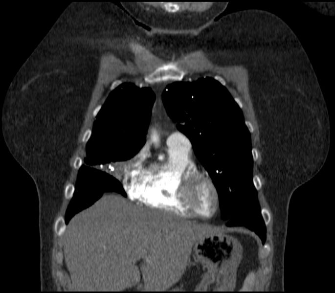 File:Adenocarcinoma of the lung (Radiopaedia 44205-47803 Coronal C+ portal venous phase 20).jpg