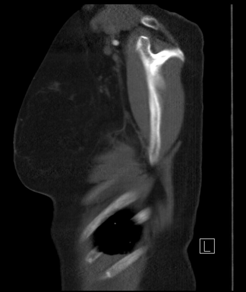 Adenocarcinoma of the lung (Radiopaedia 44205-47803 Sagittal C+ portal venous phase 3).jpg