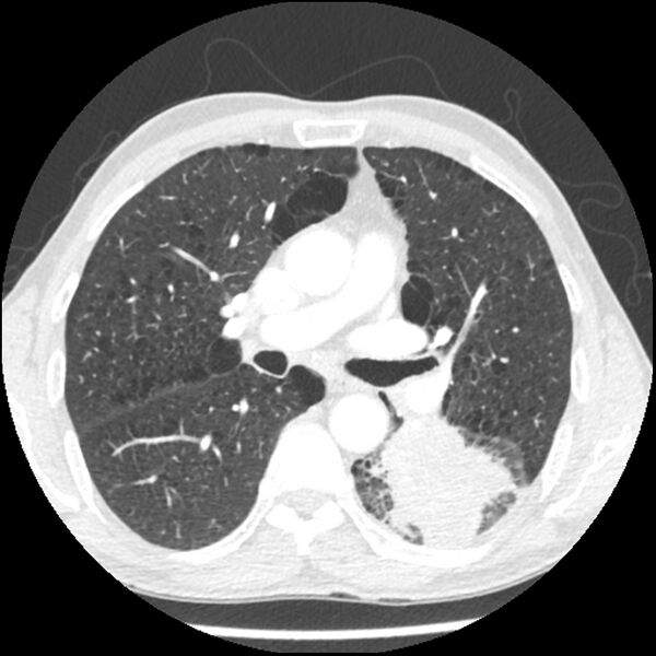 File:Adenocarcinoma of the lung - micropapillary predominant (Radiopaedia 42446-45563 C 36).jpg