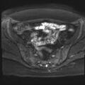Adenomyosis and endometriotic cysts (Radiopaedia 82300-96367 Axial DWI 16).jpg