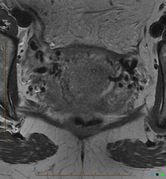 File:Adenomyosis uterus with hematometra (Radiopaedia 45779-50011 Axial T2 21).jpg